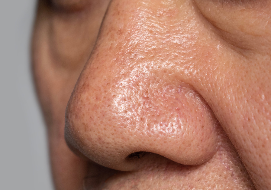 Not Blackheads: The Truth About Sebaceous Filaments